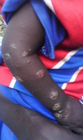 Sudan Wounds