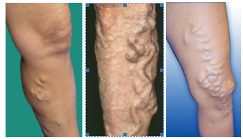 Four Common Varicose Vein Health Diseases Misconceptions