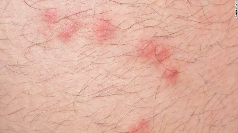 Tick bite temporarily paralyzes 3-year-old