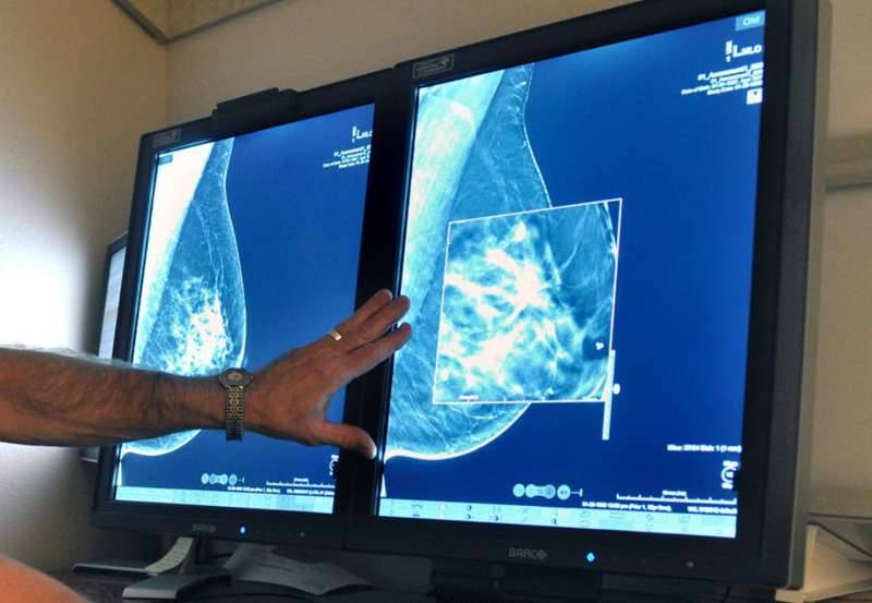 Women with advanced breast cancer are surviving longer