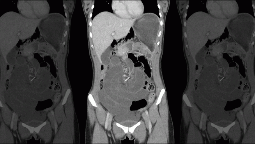 Dental brace wire lodged in intestine for a decade, doctors say