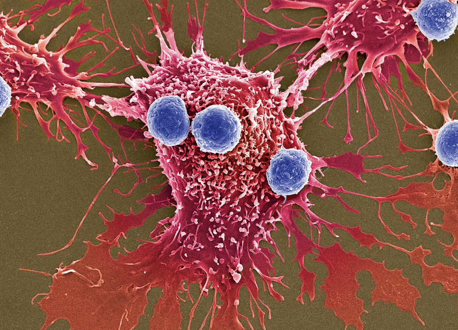 FDA approves 1st ‘living drug’ to treat cancer in the US