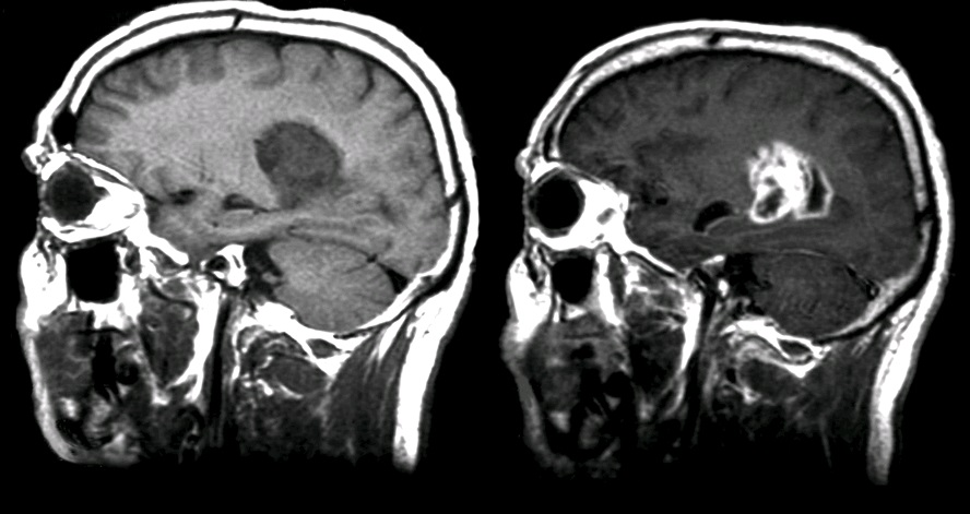 MRI contrast agents accumulate in the brain