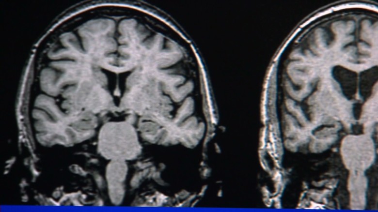The 10 warning signs of Alzheimer