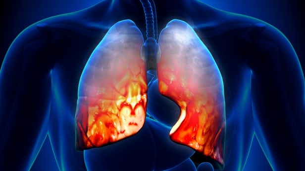 New pneumonia vaccine protects against over 70 strains of the disease