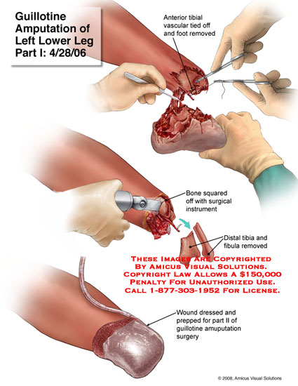 problems in care oral palliative Procedure, Reasons, Amputation: Limb Recovery problems in care oral palliative Procedure, Reasons, Amputation: Limb Recovery